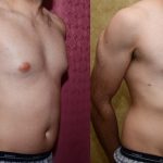 Male gynecomastia (breast) reduction Before & After Patient #12769
