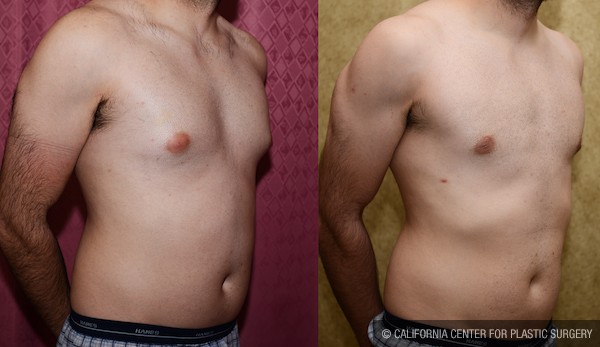 Male gynecomastia (breast) reduction Before & After Patient #12769