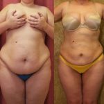 Liposuction Abdomen Plus Size Before & After Patient #12798