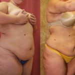 Liposuction Abdomen Plus Size Before & After Patient #12798