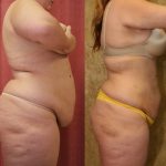 Liposuction Abdomen Plus Size Before & After Patient #12798