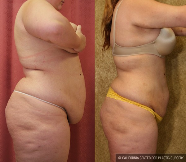 Liposuction Abdomen Plus Size Before & After Patient #12798