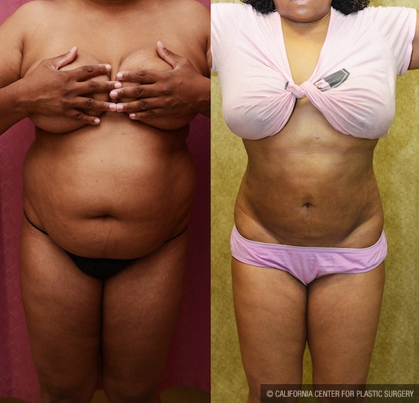 Liposuction Abdomen Medium Before & After Patient #12778