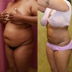 Liposuction Abdomen Medium Before & After Patient #12778