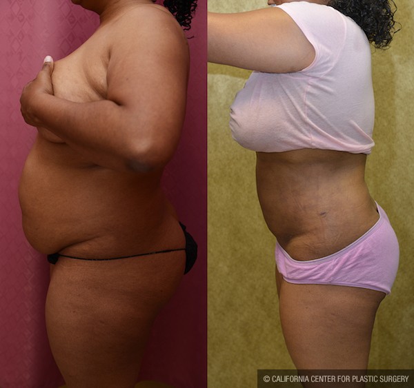 Liposuction Abdomen Medium Before & After Patient #12778
