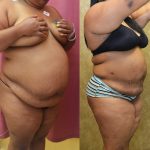 Liposuction Abdomen Plus Size Before & After Patient #12794