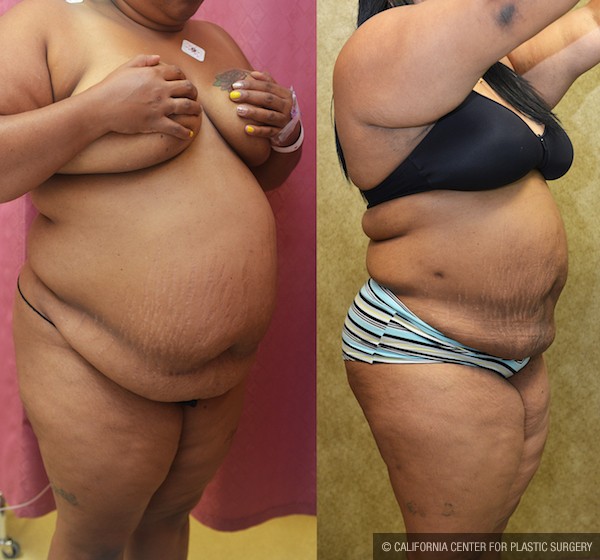 Liposuction Abdomen Plus Size Before & After Patient #12794
