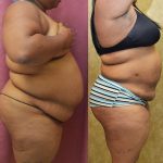 Liposuction Abdomen Plus Size Before & After Patient #12794