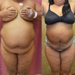 Liposuction Abdomen Plus Size Before & After Patient #12794