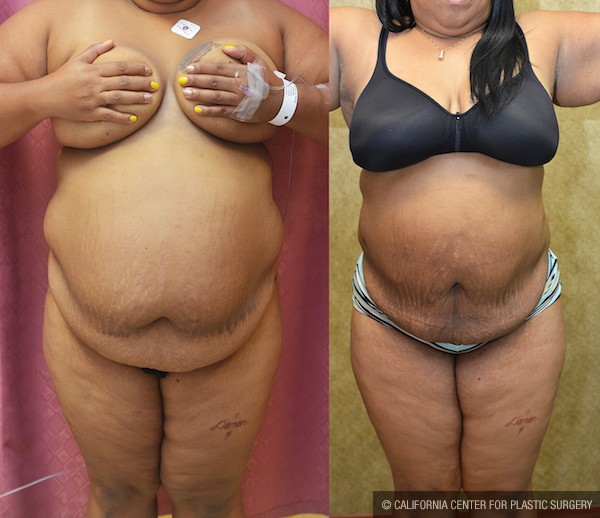 Liposuction Abdomen Plus Size Before & After Patient #12794