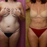 Liposuction Abdomen Medium Before & After Patient #12782