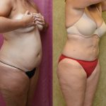 Liposuction Abdomen Medium Before & After Patient #12782