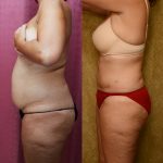 Liposuction Abdomen Medium Before & After Patient #12782