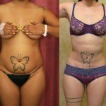 Liposuction Abdomen Medium Before & After Patient #12786