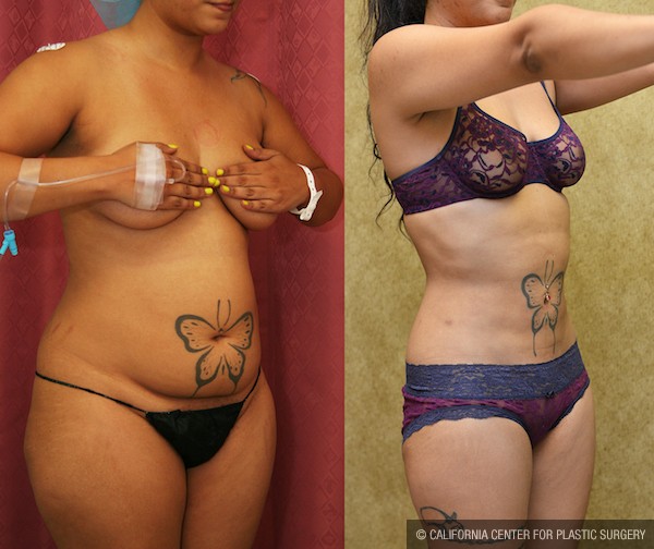 Liposuction Abdomen Medium Before & After Patient #12786