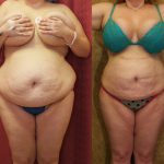 Liposuction Abdomen Plus Size Before & After Patient #12790