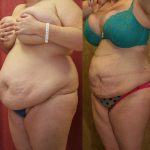 Liposuction Abdomen Plus Size Before & After Patient #12790