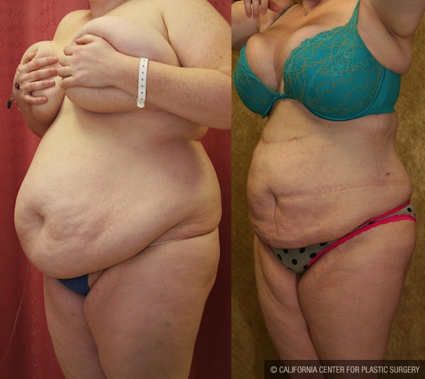 Liposuction Abdomen Plus Size Before & After Patient #12790