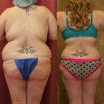 Liposuction Abdomen Plus Size Before & After Patient #12790