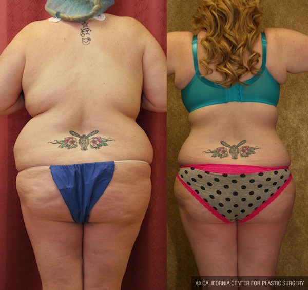 Liposuction Abdomen Plus Size Before & After Patient #12790