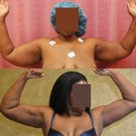 Liposuction Arms Before & After Patient #12805