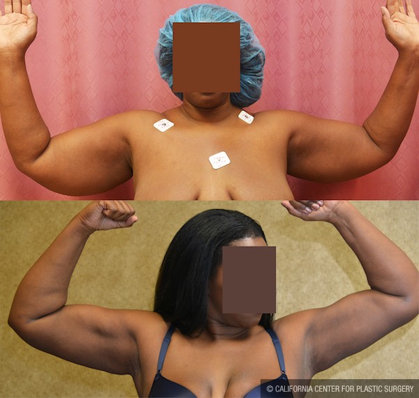 Liposuction Arms Before & After Patient #12805