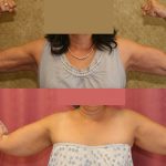 Liposuction Arms Before & After Patient #12802