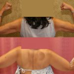 Liposuction Arms Before & After Patient #12802