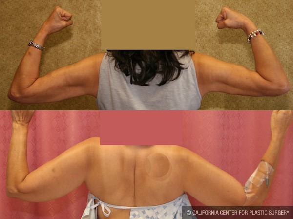 Liposuction Arms Before & After Patient #12802