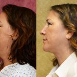 Neck & Face Liposuction Before & After Patient #12808