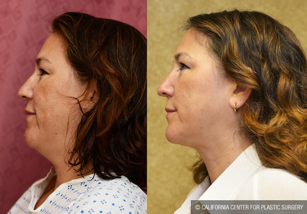 Neck & Face Liposuction Before & After Patient #12808