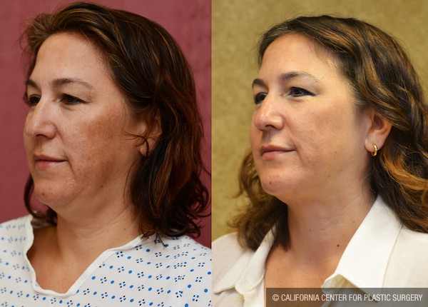 Neck & Face Liposuction Before & After Patient #12808