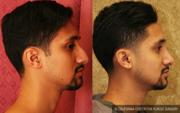 Neck & Face Liposuction Before & After Patient #12815