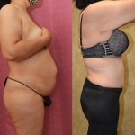 Tummy Tuck (Abdominoplasty) Medium Size Before & After Patient #13014