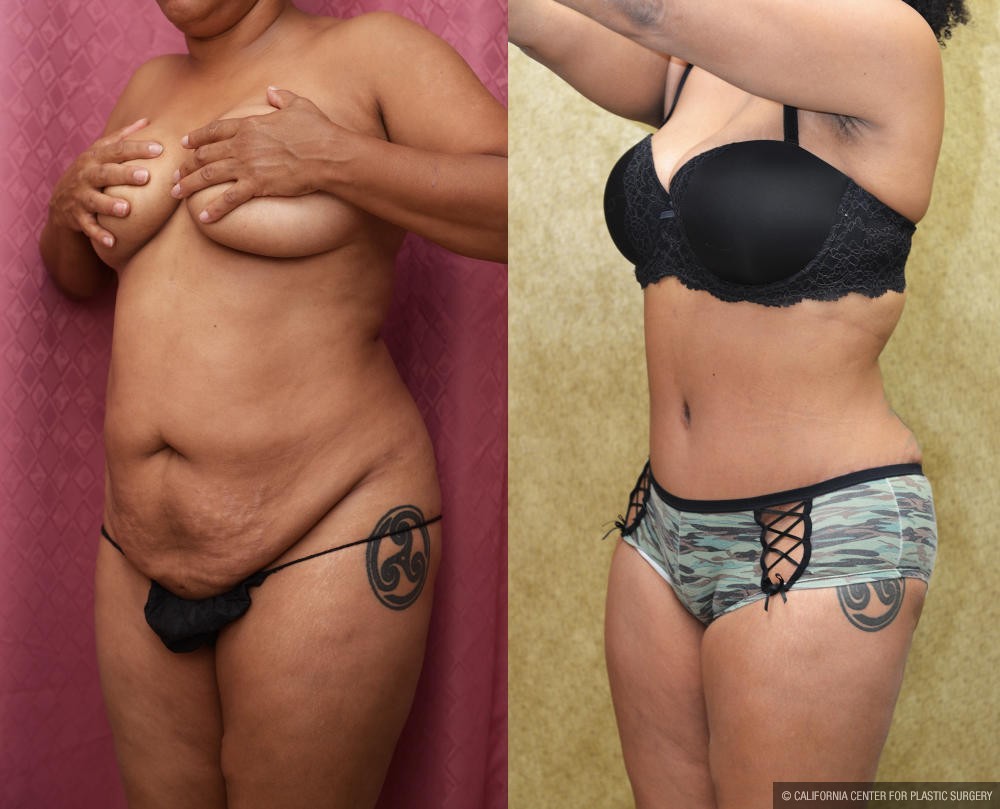 Tummy Tuck (Abdominoplasty) Small Size Before & After Patient #13017