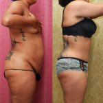 Tummy Tuck (Abdominoplasty) Small Size Before & After Patient #13017