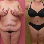 Tummy Tuck (Abdominoplasty) Plus Size Before & After Patient #13016