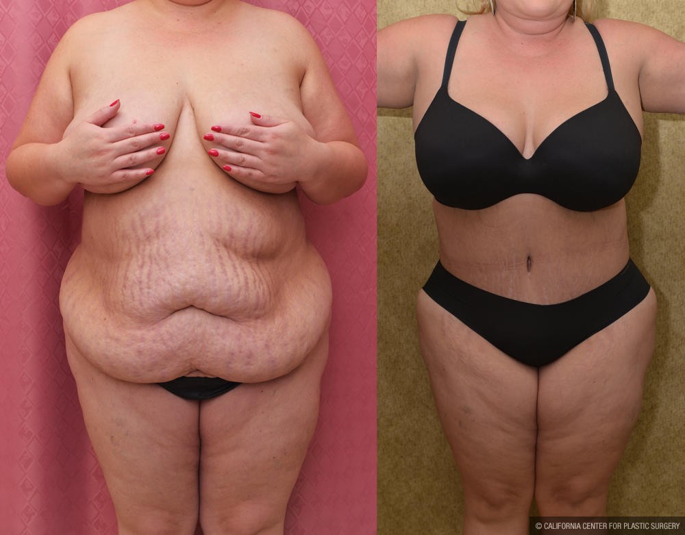 Tummy Tuck (Abdominoplasty) Plus Size Before & After Patient #13016