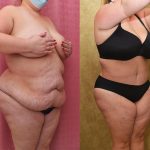 Tummy Tuck (Abdominoplasty) Plus Size Before & After Patient #13016
