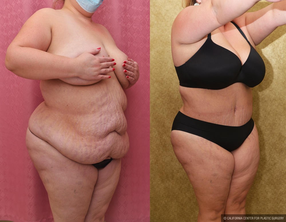 Tummy Tuck (Abdominoplasty) Plus Size Before & After Patient #13016