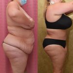 Tummy Tuck (Abdominoplasty) Plus Size Before & After Patient #13016