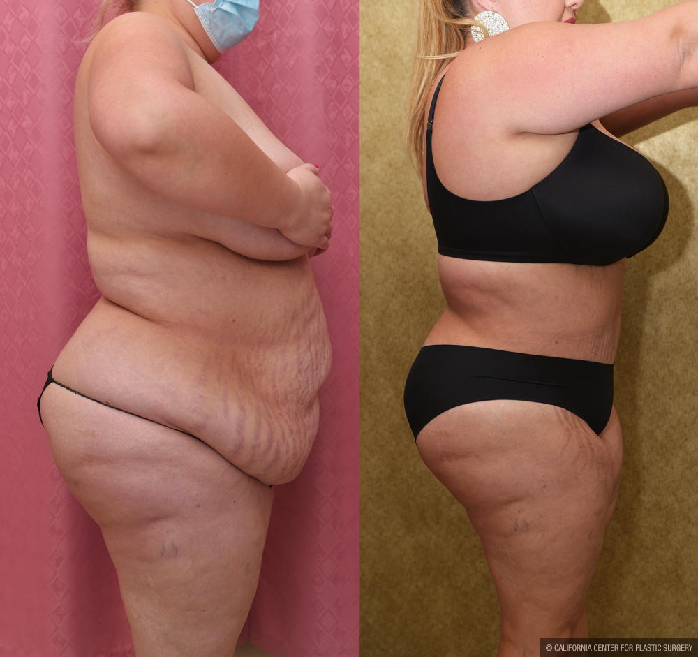 Tummy Tuck (Abdominoplasty) Plus Size Before & After Patient #13016