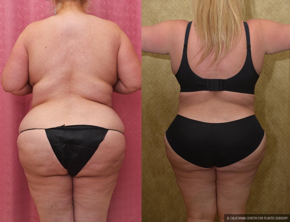 Tummy Tuck (Abdominoplasty) Plus Size Before & After Patient #13016