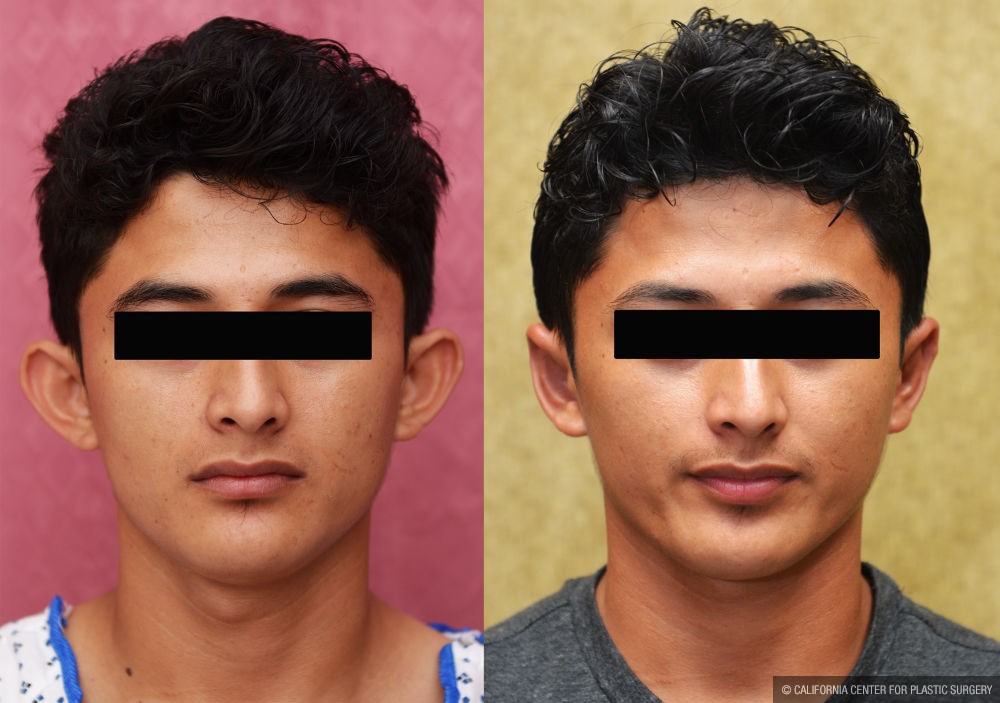 Ear (Otoplasty) Before & After Patient #12924