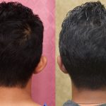 Ear (Otoplasty) Before & After Patient #12924