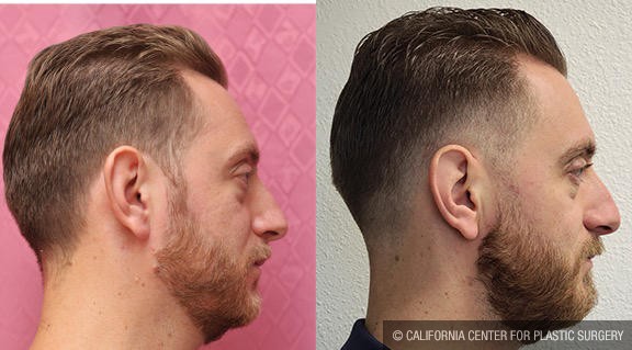 Ear (Otoplasty) Before & After Patient #12937