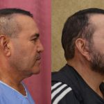 Facelift Before & After Patient #12938