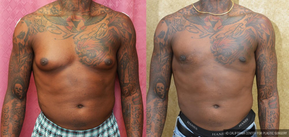 Male gynecomastia (breast) reduction Before & After Patient #12946