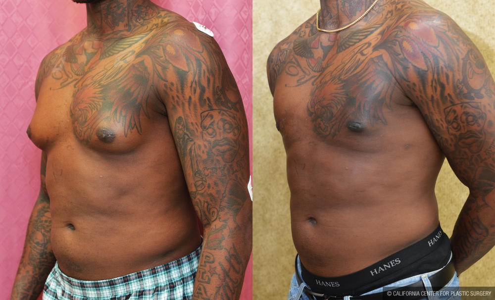 Male gynecomastia (breast) reduction Before & After Patient #12946