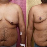 Male gynecomastia (breast) reduction Before & After Patient #12974